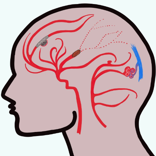 Image of Umass Neurointerventional